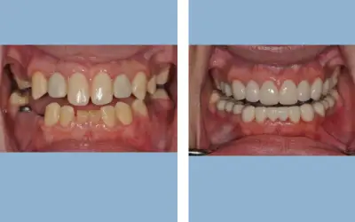 Before and After